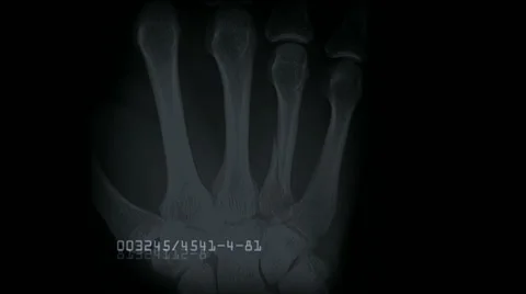 X-ray files with file numbers animation Stock-Footage 47991389