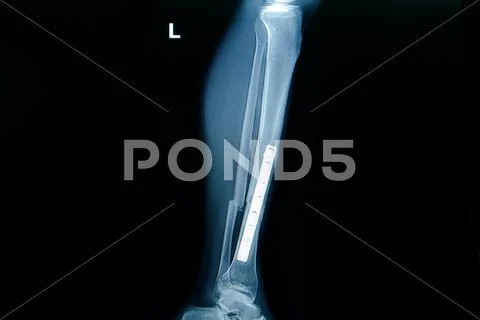 X-ray film of leg fracture,fracture of tibia and fibula with implant ...