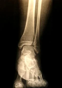 X-ray of a foot Stock Photos