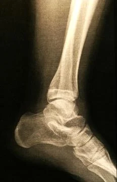 X-ray of a foot Stock Photos