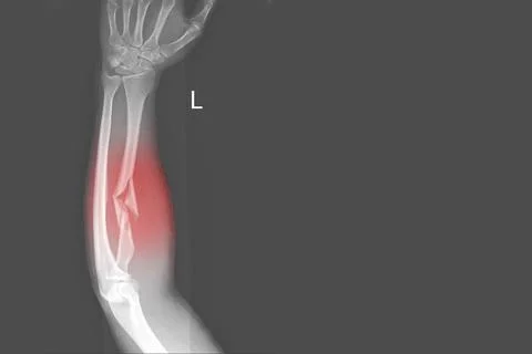 X-ray forearm AP views showing Fracture proximal Left radius and soft tissue  Stock Photos