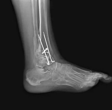 X-ray fracture of the tibia fixed with metal plate and screws 스톡 사진