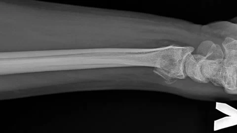 An X-ray of a fractured human bone in motion. Skeleton Anatomy Stock Footage 135040671