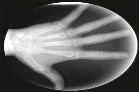 X-ray of Hand Stock Footage 41878946