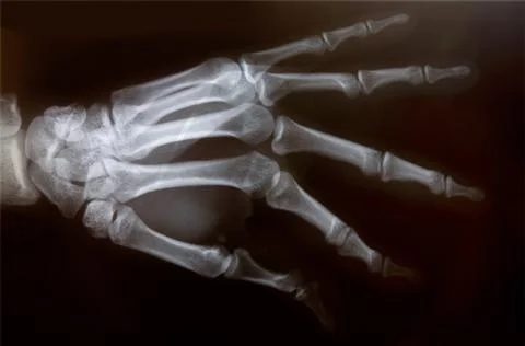 X-ray of hand Stock Photos