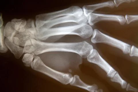 X-ray of hand Stock Photos