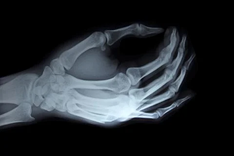 X-ray hand Stock Photos