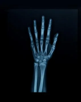 X-ray hand Foto stock