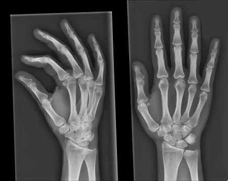 X-ray hand Stock Photos