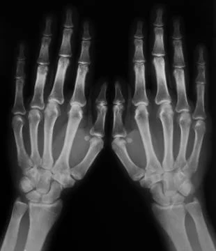 X-ray of hands Stock Photos