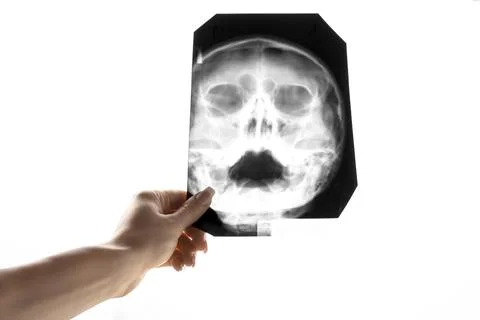 X-ray of the head. Fluorography of maxillary sinuses. Concept of medicine Stock Photos