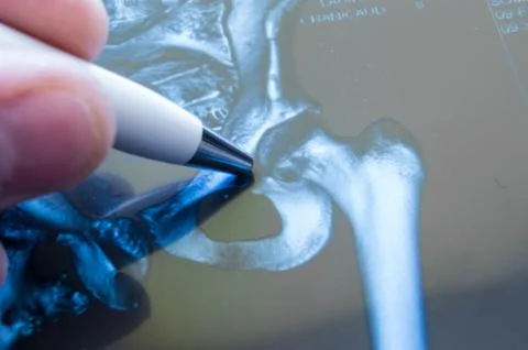 X-ray of hip joint. Doctor pointed on area of hip joint Stock Photos