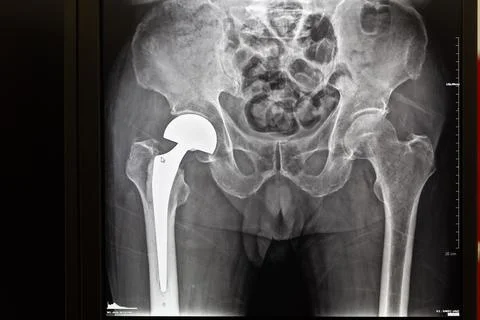 X-ray of hip joint endoprostheses on the monitor screen Stock Photos