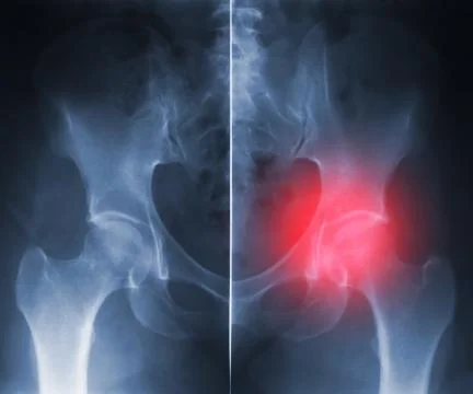 X-ray hip trauma Stock-Illustration