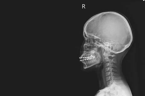 X-ray of human cervical spine and  head skull Stock Photos