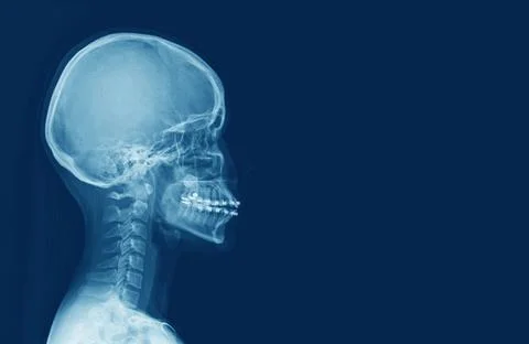X-ray of human cervical spine and  head skull Stock Photos