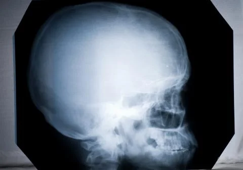 X-ray of a human head. Stock Photos