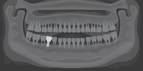 X-ray of human jaw with normal teeth and dental implant. Radiograph with Stock Illustration