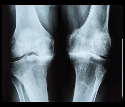 X-ray of human knee Stock Photos