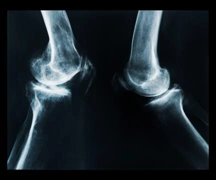 X-ray of human knee Stock Photos