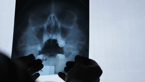 X-ray of the human skull of an older man Stock Footage 144384835