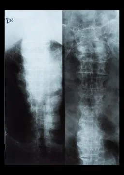 X-Ray of human spinal column Stock Photos