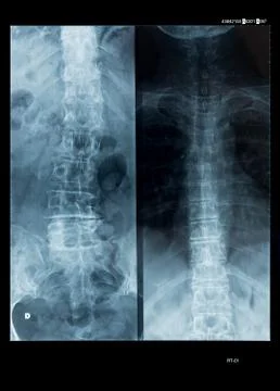 X-Ray of human spinal column Stock Photos