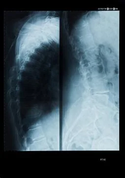 X-Ray of human spinal column Stock Photos