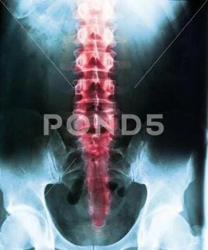 X-ray of the human spine and pelvis against a dark background ~ Premium ...