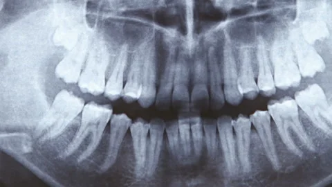 X-ray of human Stock Video Pond5