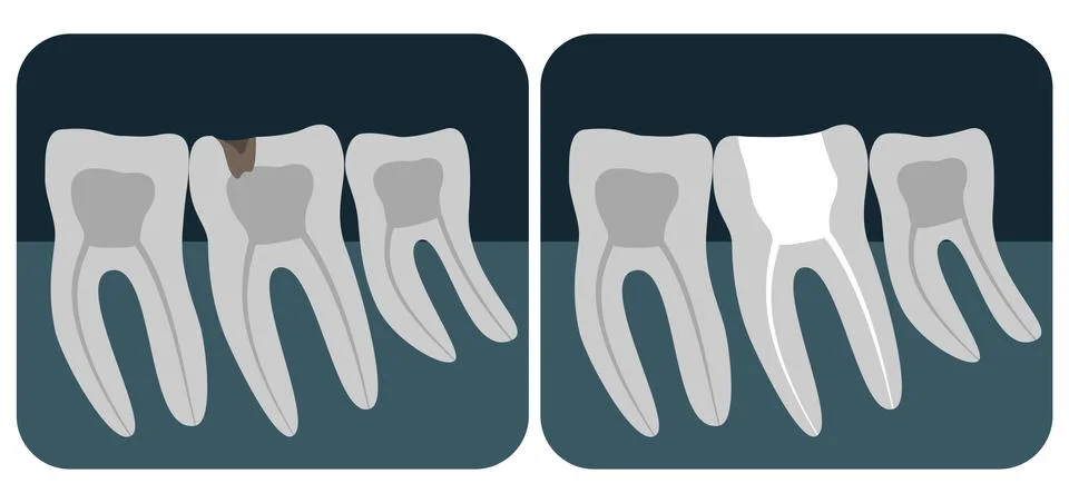X-ray of human teeth. Three healthy molars on an x-ray. Vector illustration. Stock Illustration