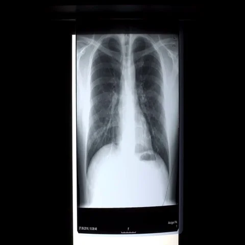 X-ray on illuminator panel - Rib Stock Footage 69408535