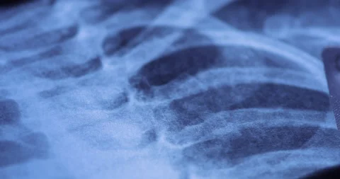 X-ray image and blister pack of white tablets Stock Footage 233341564