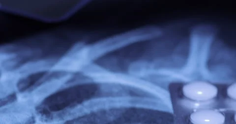 X-ray image and blister pack of white tablets Stock-Footage 233341749