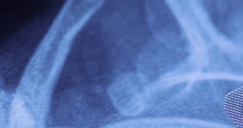 X-ray image and blister pack of white tablets Stock-Footage 233342613