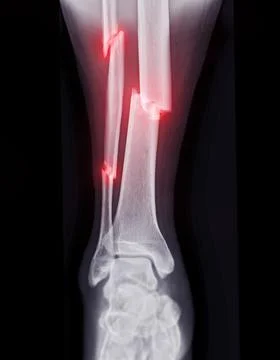 X-ray image of ankle joint showing fracture tibia and fibula bone.' Stock Illustration