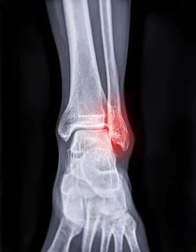 X-ray image of ankle joint showing fracture of ankle joint.. Stock Illustration