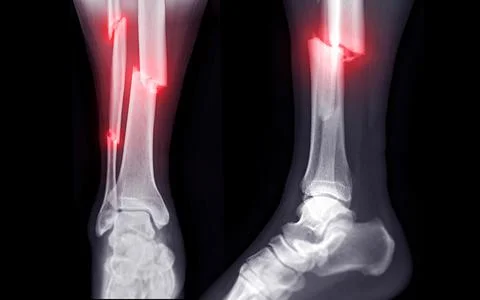 X-ray image of ankle joint showing fracture tibia and fibula bone.' Stock Illustration