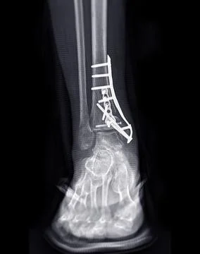 X-ray image of ankle joint showing surgical treatment by internal fixation wi Stock-Illustration