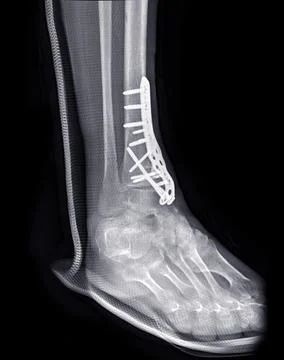 X-ray image of ankle joint showing surgical treatment by internal fixation wi Stock Illustration