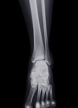 X-ray image of ankle joint for diagnosis fracture tibia and fibula bone. Stock Illustration
