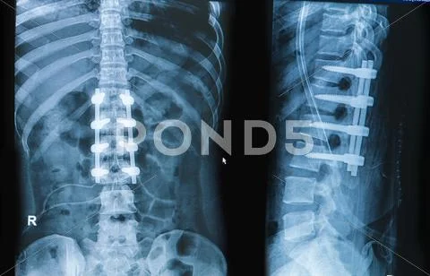 X-ray image of back pain show spinal column with implant fusion Stock Photos