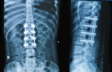 X-ray image of back pain show spinal column with implant fusion Foto stock