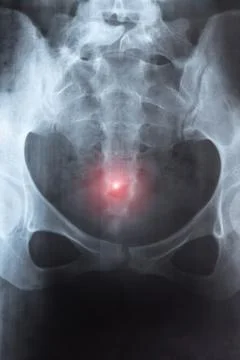 X-ray image of big hernia in pelvic spine. Orthopedic treatment. Diagnostic.. Stock Photos