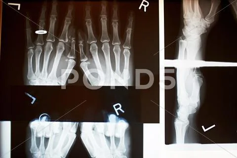 X Ray Image Of Bones In Hand