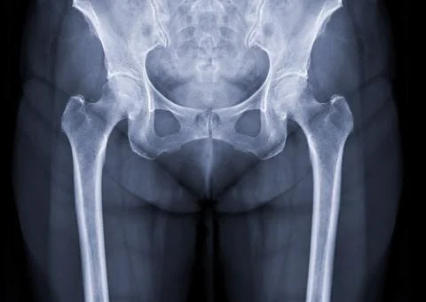 X-ray image of Both hip joint. Stock Photos
