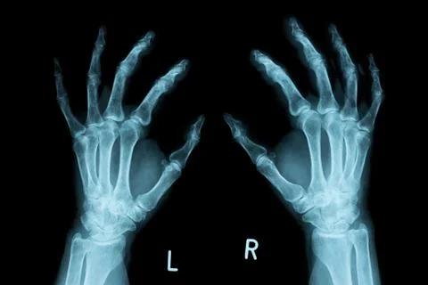 X-ray Image of both human hands Fotos de archivo