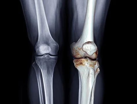 X-ray image of  both knee AP view for diagnostic Osteoarthritis or knee fra.. Stock Illustration