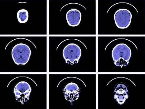 X-ray image of the brain computed tomography Illustrazione stock