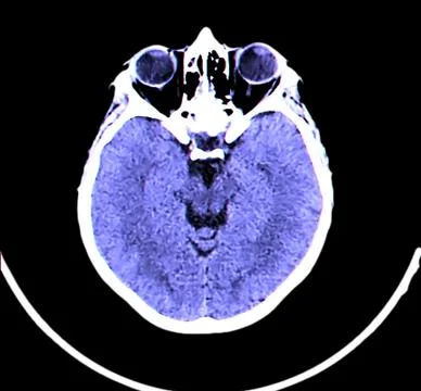 X-ray image of the brain computed tomography Illustrazione stock